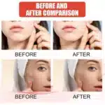 144pcs Acne Patch Set - Invisible Spot Stickers for All Skin Types - Image 6